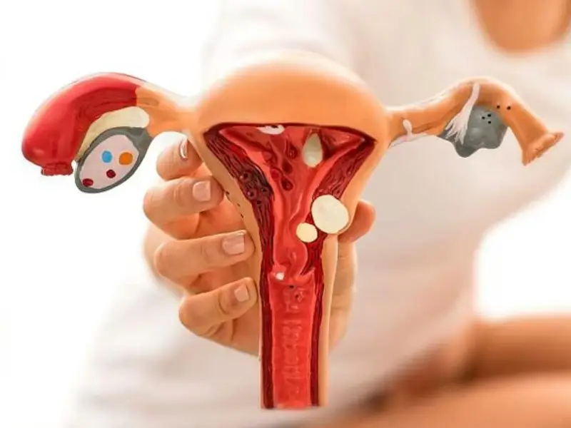 سونوگرافی آندومتریوز