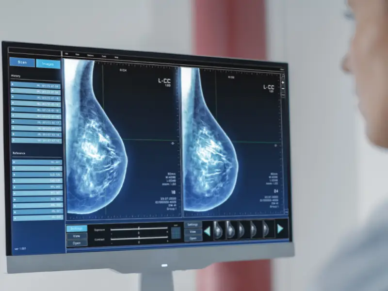 تفسیر نتیجه ماموگرافی