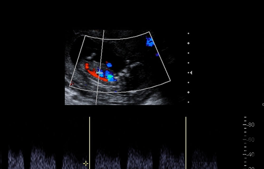 سونوگرافی کالر داپلر چیست و سونوی داپلر در چه مواقعی تجویز می‌شود؟