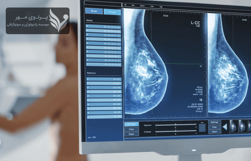 آیا بیوپسی سینه درد دارد؟ ماموگرافی چیست و چرا انجام آن ضروری است؟ همه چیز درباره سن مناسب و آمادگی برای ماموگرافی