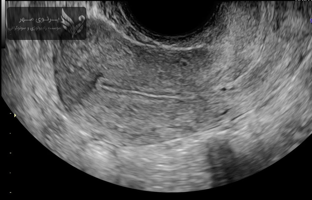 سونوگرافی آندومتریوز چیست؟