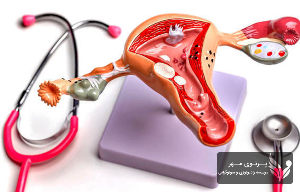 سونوگرافی آندومتریوز چیست؟