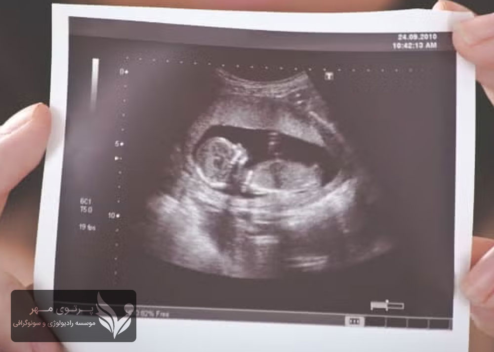 سونوگرافی رحم و تخمدان: بررسی سلامت رحم و تخمدان‌ها