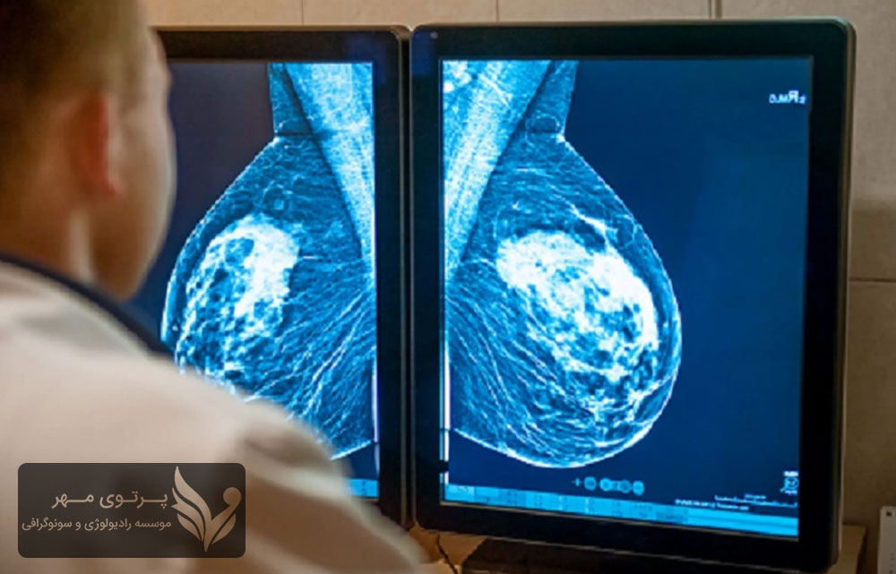 چکاپ کامل پستان: شناسایی توده‌ها و مشکلات پستان