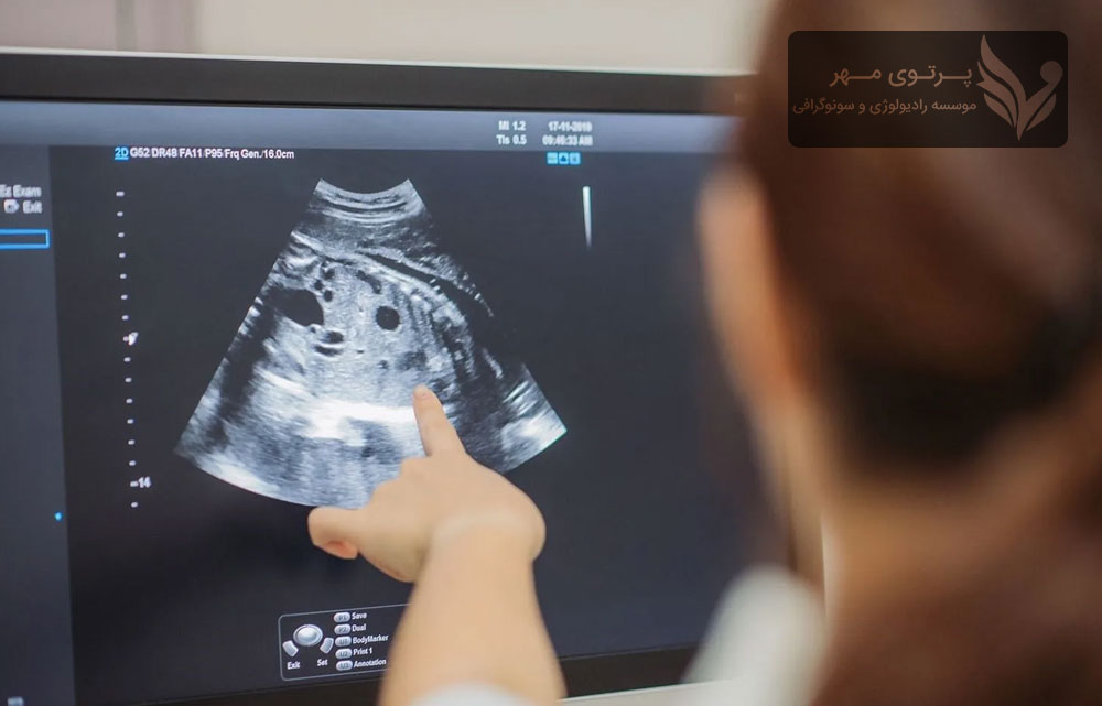 هزینه غربالگری اول و دوم