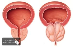 پروستاتیت یا التهاب پروستات؛ علائم، تشخیص و روشهای درمان موثر