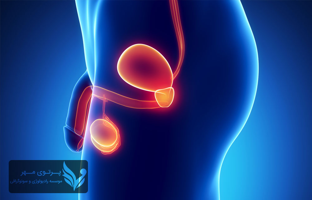 التهاب پروستات چیست؟