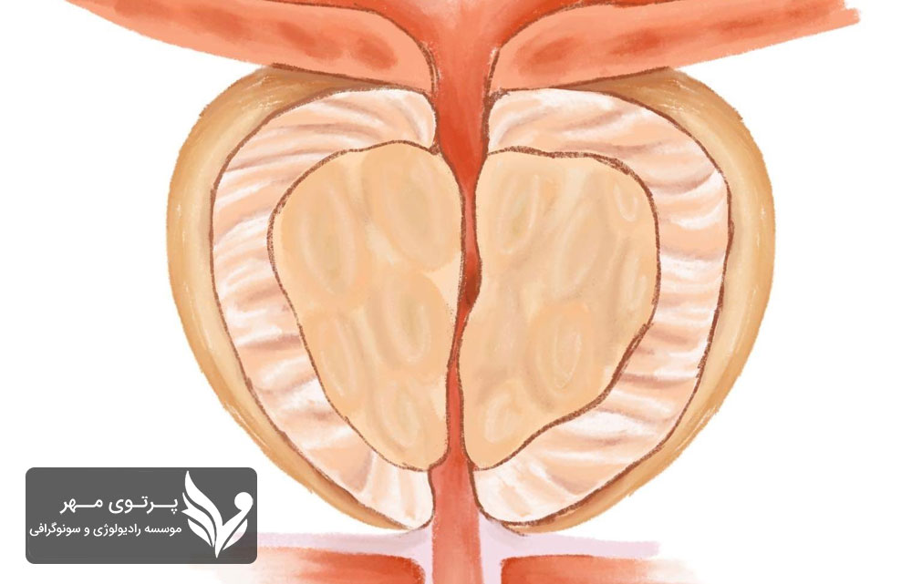 روش‌های درمان التهاب پروستات