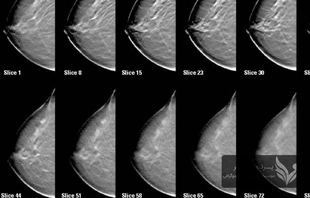 توموسنتز چیست و چگونه به تشخیص سرطان سینه کمک می‌کند؟