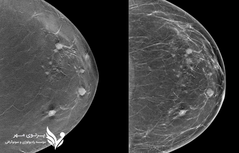 توموسنتز سه بعدی