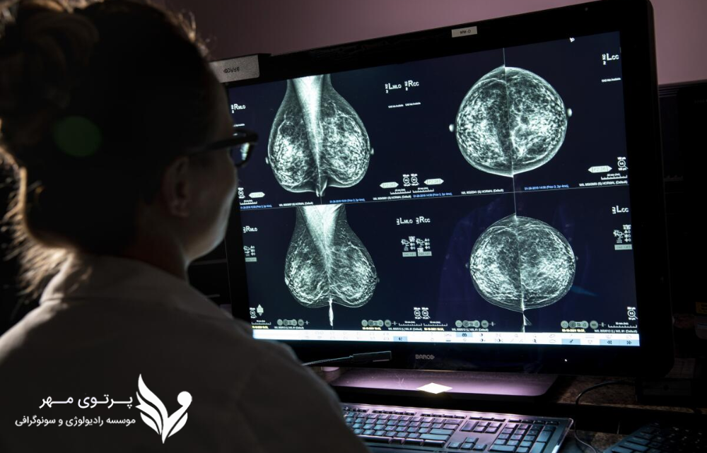 تشخیص سرطان سینه